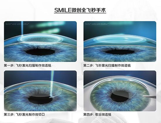蔡司全飛秒、蔡司半飛秒近視手術(shù)與蔡司全飛秒flex手術(shù)