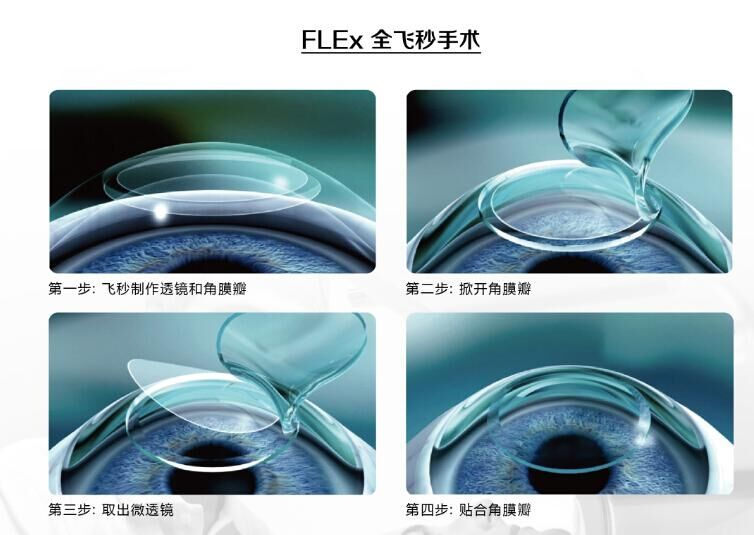 蔡司全飛秒、蔡司半飛秒近視手術(shù)與蔡司全飛秒flex手術(shù)