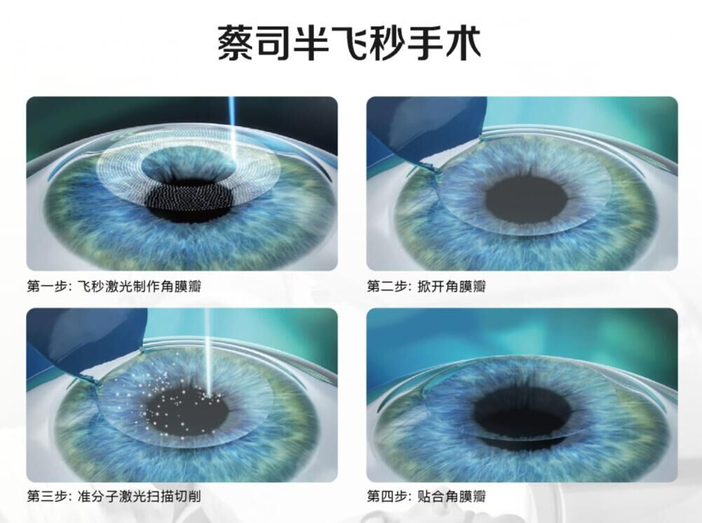 TransPRK手術(shù)與蔡司全飛秒手術(shù)、半飛秒手術(shù)有什么區(qū)別?