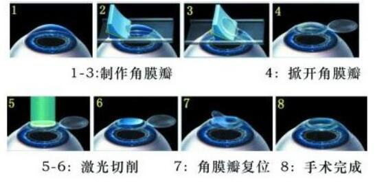 準(zhǔn)分子激光手術(shù)到底是怎么治 愈你的眼睛的？