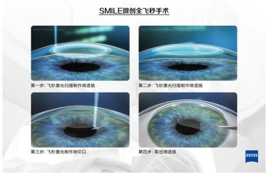 準(zhǔn)分子激光手術(shù)到底是怎么治 愈你的眼睛的？