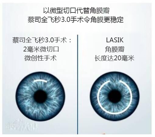 做完近視手術要休息多長時間？需要住院嗎？
