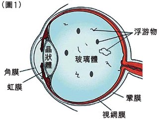 眼前有黑點飄，視物有些變形是什么眼病