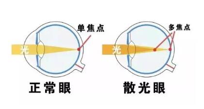 近視和散光，手術(shù)能同時矯正嗎？